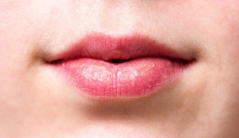 Solutions for Lip fillers migration