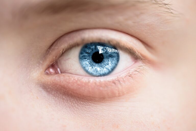 Fillers Under Eyes Gone Wrong